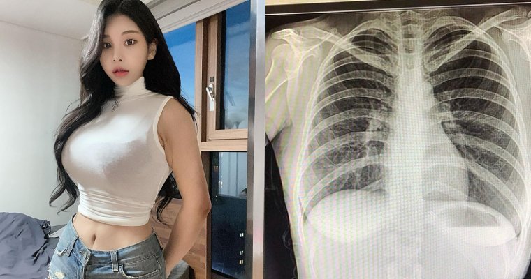 【蜗牛娱乐】南韓「百萬網紅」不滿被質疑整形…曬 X 光照自證清白：我沒有動過手術