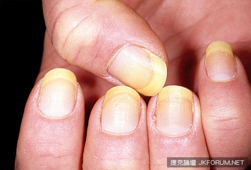 【蜗牛娱乐】從指甲的狀態看出你的健康狀況，來看看你中了幾項！